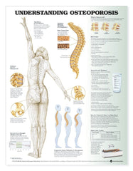 Understanding Osteoporosis