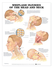 Whiplash Injuries of the Head and Neck